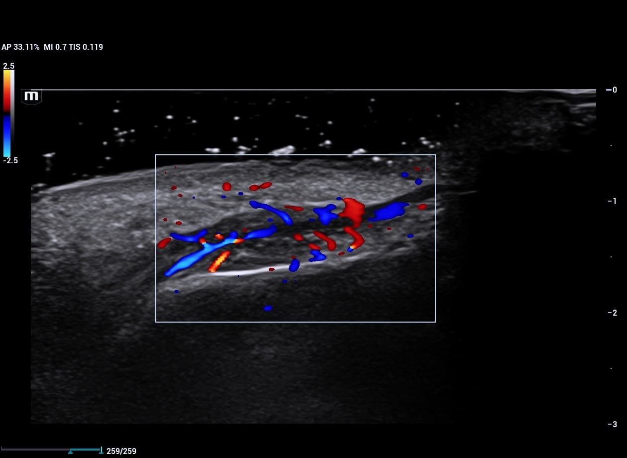 Exame de doppler dermatológico colorido